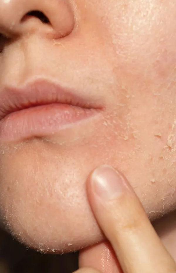 Dryness