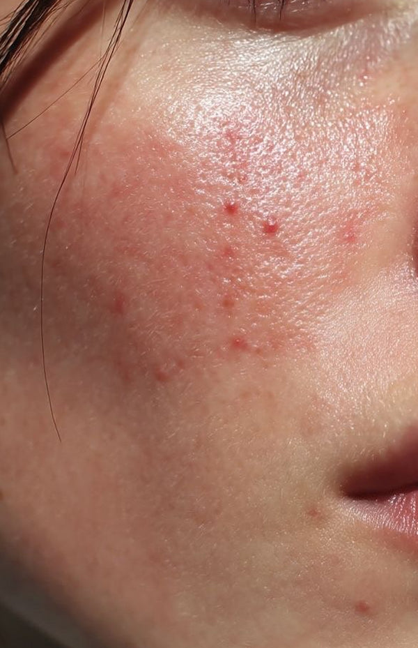 Uneven Skin Tone